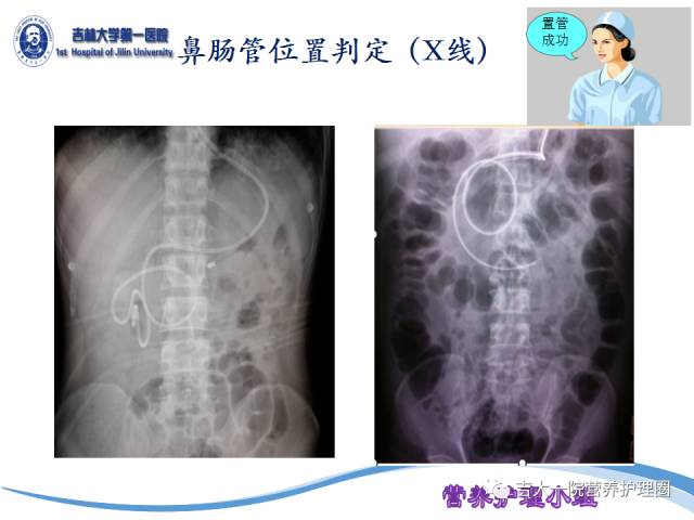 最新鼻腸管護(hù)理PPT解讀與應(yīng)用探討，專(zhuān)業(yè)護(hù)理指南與實(shí)踐探討