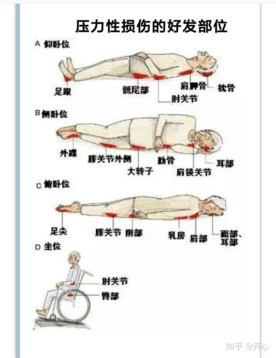 最新壓瘡護(hù)理措施研究與應(yīng)用的進(jìn)展