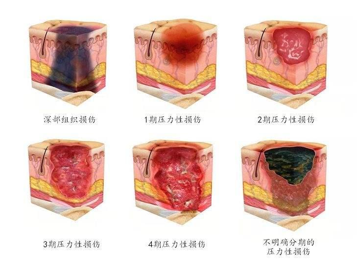 壓瘡最新分期與護(hù)理方法詳解