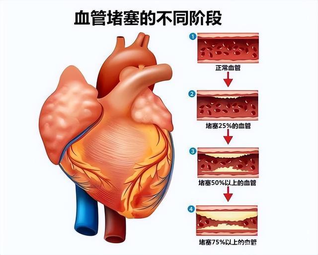 最新血管堵塞治療方法研究與進(jìn)展概述